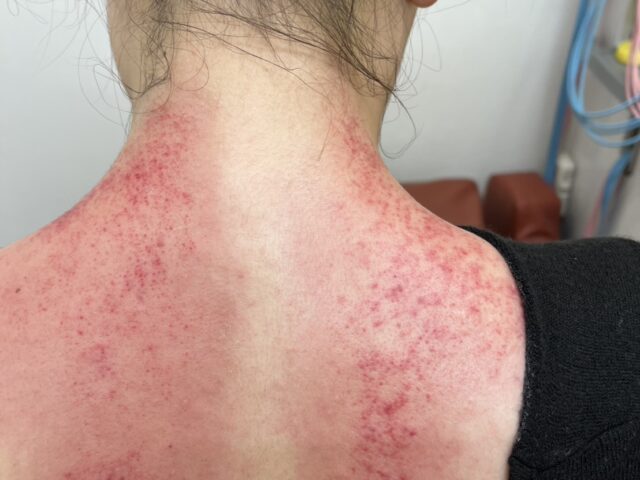 当院人気のカッサ療法　　宇都宮　とば整骨院