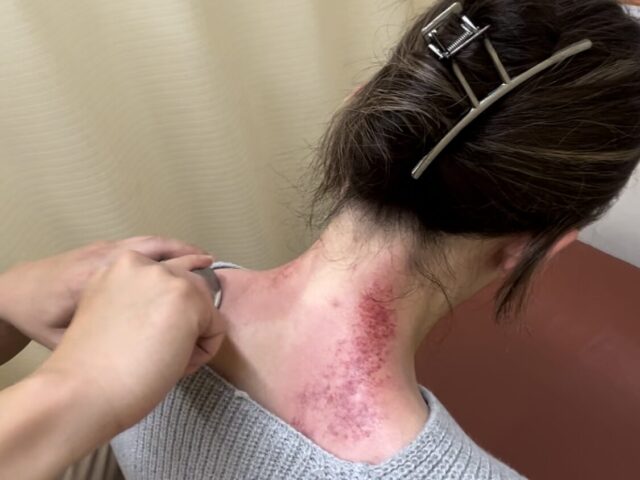 慢性的な肩こりの症例報告　　宇都宮　とば整骨院