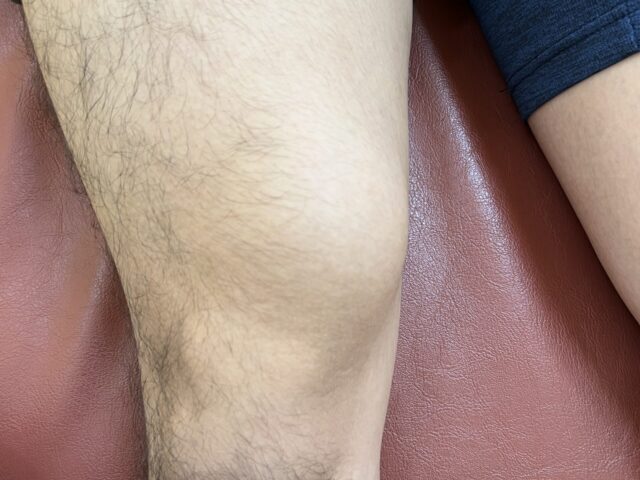 膝上の膨らみ(骨変性)の症例報告　　宇都宮　とば整骨院