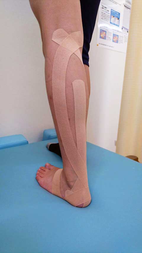 膝のテーピング実施例1